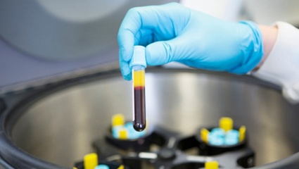 Investigación-Reino Unido: Afirman que un análisis de sangre puede detectar un 86% de los casos de cáncer de ovario